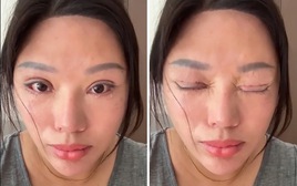 Phẫu thuật mí mắt hỏng, nạn nhân còn bị kiện ngược