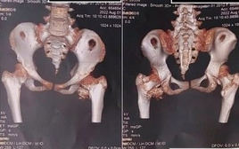 Bé gái 12 tuổi mắc "hội chứng người hóa đá" hiếm gặp, bố mẹ ngỡ ngàng khi bác sĩ nhắc tới cú ngã xe đạp 2 năm trước