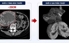 Khối u gan “lớn nhanh như thổi”, tăng kích thước 10 lần sau khi uống loại nước này thường xuyên