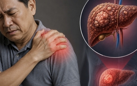 Cảnh báo 1 TÍN HIỆU cực quan trọng của ung thư gan: Nhiều người còn cố cãi chỉ đau vai thông thường