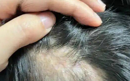 Bé gái 5 tuổi rụng tóc hói vĩnh viễn cả 1 mảng vì 1 hành động tưởng chừng vô hại