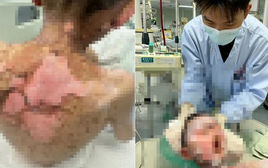 Bé trai 9 tuổi bong tróc da, loét khắp cơ thể, vảy dính kín mắt miệng, nguyên nhân từ 1 loại thuốc thông dụng trong mọi gia đình