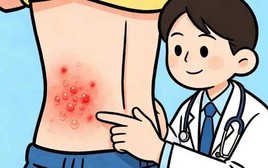 Đau đến mất ngủ nhiều đêm, bệnh zona thần kinh không còn là "bệnh người già": Cảnh báo 4 dấu hiệu miễn dịch suy yếu mà người trẻ bỏ qua