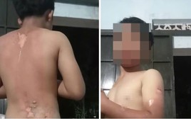 Mẹ ruột khai nguồn cơn tạt nước sôi vào người con trai, gây bỏng