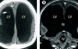 1 người đàn ông 44 tuổi mất tới 90% não bộ nhưng vẫn sống và làm việc bình thường: Chuyện gì đã xảy ra?