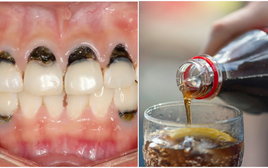 Người phụ nữ 30 tuổi cả hàm chân răng đen sì, mùi hôi nồng nặc vì 1 loại nước vạn người mê