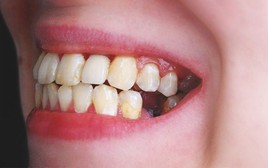 Vì sao nhiều người mất răng nhưng không chịu trồng?