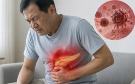 Ung thư tuyến tụy thường "ngụy trang" thành bệnh dạ dày: 6 thay đổi của cơ thể nhiều người dễ bỏ qua