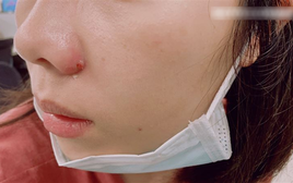 Nặn mụn quanh miệng, người phụ nữ bị sưng tấy từ môi lên tận sống mũi, bác sĩ cảnh báo: Sai lầm ở 1 điểm!