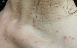 Cảnh báo: Các bệnh ung thư rất dễ "ngụy trang" dưới hình dạng của 4 loại mụn này