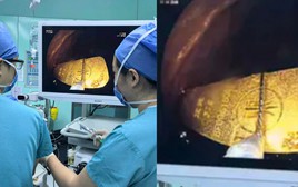 Bé gái 5 tuổi nuốt thỏi vàng 50gr, các bác sĩ nội soi gắp thành công
