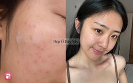 Vì sao dưỡng da quá nhiều lại có thể khiến làn da ngày càng xấu đi?