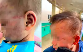 Khởi tố cha dượng đánh bé 3 tuổi bầm tím mặt mũi