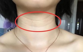 Một khi 3 hiện tượng này xuất hiện trên cổ bạn: Đừng bất cẩn, nên đi khám ngay