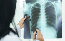 "Thủ phạm" gây xơ phổi không hồi phục, đôi khi tử vong nhanh hơn cả ung thư