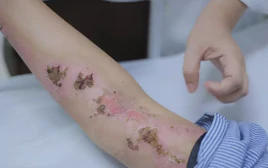 Cô gái gục xuống giữa cánh đồng sau cú sét đánh