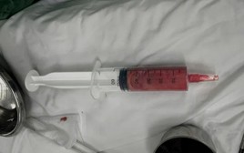 Bệnh viện Trung ương Quân đội 108 cảnh báo những người tiêm filler 5-10 năm trước