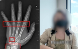 Bé gái đã có tuổi xương "chạy trước" gần 3 năm, đây là 4 sai lầm mà cha mẹ Việt thường mắc phải