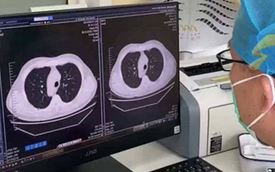 Cảm lạnh và ho, phổi trái của nam sinh đột nhiên "biến mất": Bác sĩ tiết lộ nguyên nhân nhiều người phải cẩn thận
