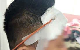 Ngã xe máy, một tháng sau mới lộ chấn thương sọ não