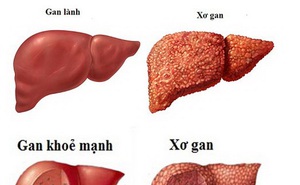 Xơ gan khó chữa nhưng dễ phòng