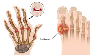 Gout - căn bệnh của giới nhà giàu?
