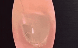 Video: Rợn người chứng kiến cảnh con nhện bò trong ống tai của người phụ nữ