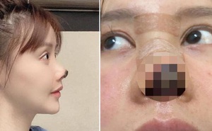 Nữ diễn viên Trung Quốc phẫu thuật thẩm mỹ tới nỗi rụng cả mũi, ngượng không dám thò mặt ra đường