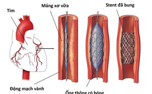 Yêu cầu báo cáo việc bệnh nhân đặt stent động mạch vành từ năm 2015 đến nay