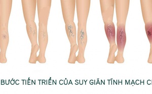 Bài tập cho người suy giãn tĩnh mạch chân