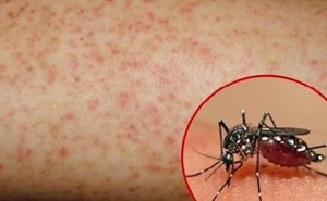 Coi chừng biến chứng nguy hiểm của sốt xuất huyết ngày mưa