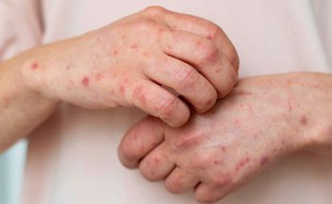 Tại sao cơ thể của chúng ta lại bị dị ứng?