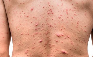 Số ca thủy đậu ở Hà Nội tăng cao, chuyên gia chỉ cách phòng tránh