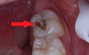 Chuyện gì sẽ xảy ra nếu có một lỗ hổng trên bề mặt răng mà bạn không điều trị ngay?