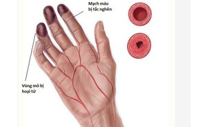 3 dấu hiệu bất thường ở tay chân: 80% khả năng bạn bị tắc mạch máu, nên xử lý ngay