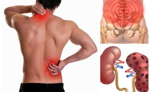 Nam giới đau lưng có phải bị mắc bệnh thận không: 4 yếu tố liên quan cần xem xét ngay