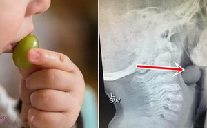 Bác sĩ nhi cảnh báo bố mẹ bỏ qua loại trái cây này khi đi siêu thị nếu không muốn "đau tim" vì con bị hóc nghẹn