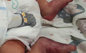 Bé sơ sinh gãy chân vì mẹ sinh con ở nhà