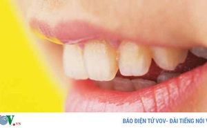 Nguyên nhân khiến răng xỉn màu và cách đối phó