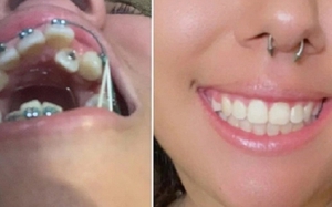 20 bức ảnh chứng minh niềng răng thay đổi nụ cười của bạn ra sao