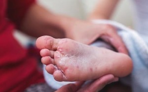 Số ca mắc tay chân miệng ở Hà Nội tăng, phát hiện thêm ổ dịch mới