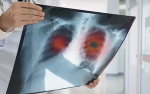 32 tuổi sống lành mạnh, sức khỏe tốt: Có 1 triệu chứng kéo dài 2 tuần, đi khám bỗng nhận kết quả K phổi