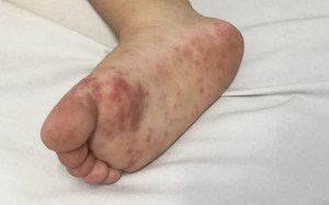 Dịch tay chân miệng “nóng” trở lại, trẻ nhỏ đối mặt nguy cơ biến chứng nặng