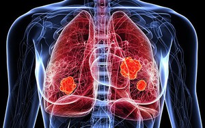 Con số đáng lo ngại về ung thư phổi tại Việt Nam