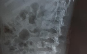 Phẫu thuật lấy chiếc kim khâu dài 17mm 'đi lạc' vào cơ thể bé gái 3 tuổi
