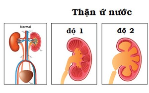 Cách phát hiện sớm thận ứ nước