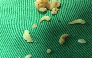 Lấy gần 20 chiếc răng cho bé 12 tuổi bị khối u răng hiếm gặp