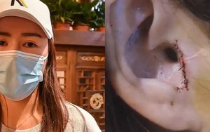 Gái xinh đi sửa mũi bị thẩm mỹ viện "tiện dao" cắt luôn một mẩu tai
