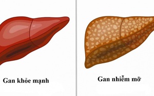 Gan nhiễm mỡ có nguy hiểm?