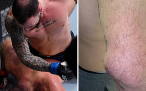Nhà cựu vô địch MMA bỗng phải nhận trận thua thất vọng, nhiều người trách móc cho đến khi nhìn thấy chấn thương kinh hoàng trên tay anh này